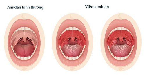 Viêm amidan mãn tính điều trị như thế nào?