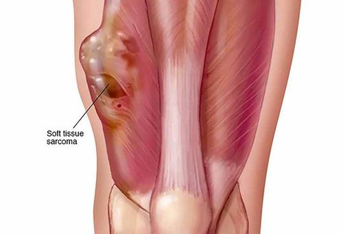 Sarcoma bao hoạt dịch đơn pha có nguy hiểm không?