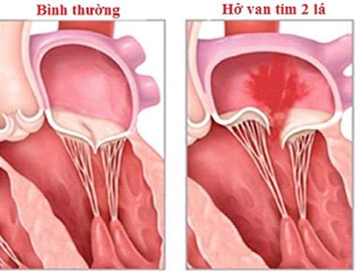 Kỹ thuật TAVI có áp dụng cho thay van tim 2 lá được không?