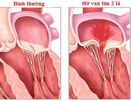 Very mild mitral regurgitation is mild valvular regurgitation?