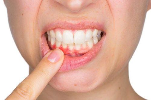 Chảy dịch vùng nướu răng cửa dưới điều trị như thế nào?