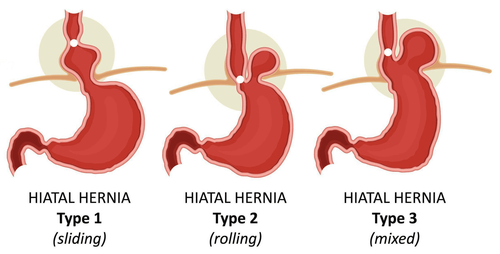 Can a diaphragmatic hernia be operated on?