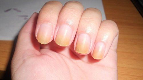 What is yellow nail syndrome?