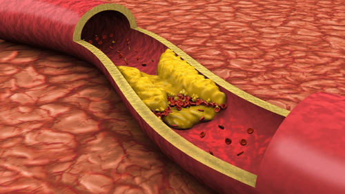 Disorders of blood lipid metabolism