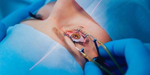 What you need to know about vision surgery (ICL)