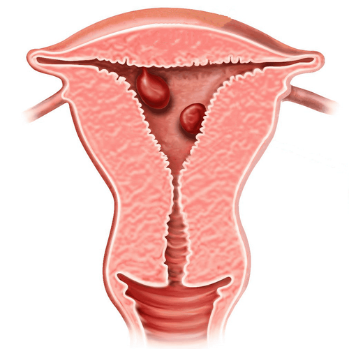 Endometrial polyps: Symptoms you should know