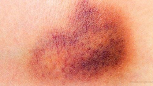 Should hot compresses dissolve bruises?