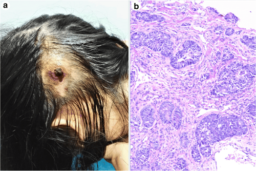 Adenocarcinoma là gì?