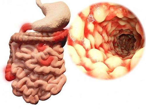 Classification of the 5 types of Crohn's disease