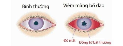 Có thể phẫu thuật điều trị viêm màng bồ đào được không?