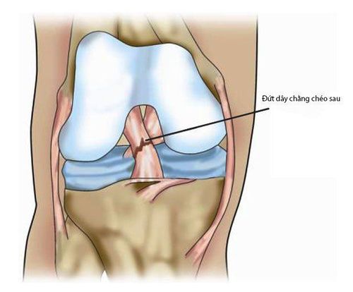 Đứt dây chằng chéo sau, khi nào cần phẫu thuật?