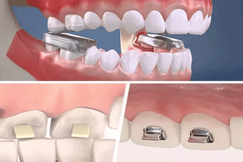 The effect of raising the bite in braces