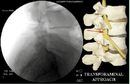 
Hình 1. Tiêm thấm ngoài màng cứng qua lổ liên hợp (nguồn: completepaincare.com)
