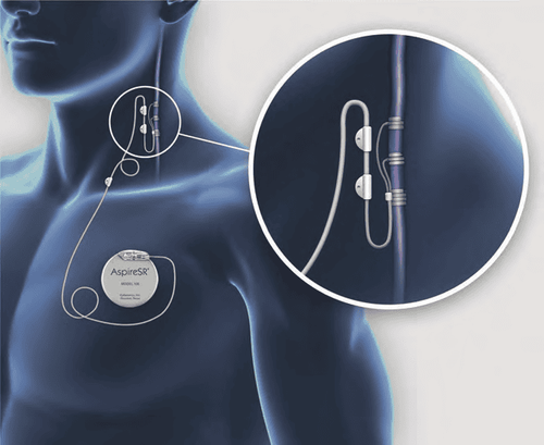 
Hình 3. Kích thích dây thần kinh phế vị trong điều trị động kinh (nguồn: Cyberonics)
