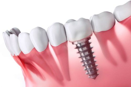 Does dental implant have any effect?