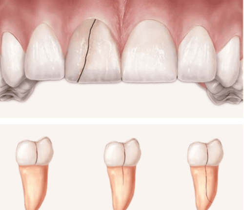 Is a cracked tooth dangerous and does it heal on its own?