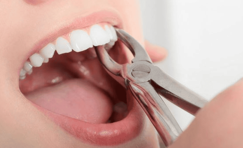 Khi nào phải nhổ răng vĩnh viễn? Có ảnh hưởng gì không?