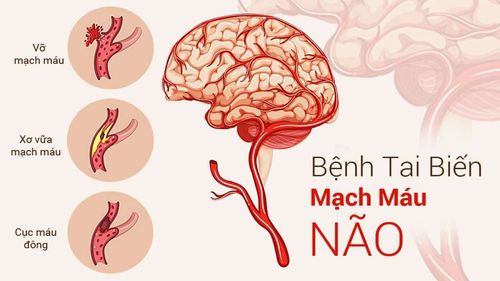 Bị liệt tay chân sau tai biến nhồi máu não có hồi phục được không?