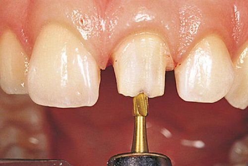 Mài răng đau không và được chỉ định trong trường hợp nào?