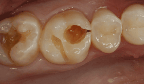 The tooth number 6 on the upper jaw is decayed, should it be extracted?