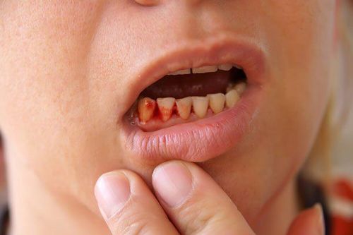 What medicine should I take for bleeding gums?