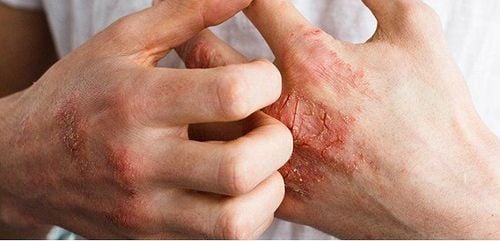 8 cách giảm đau do viêm khớp vảy nến