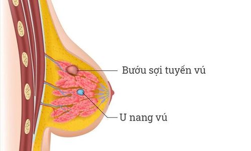 Effect of fibroadenoma