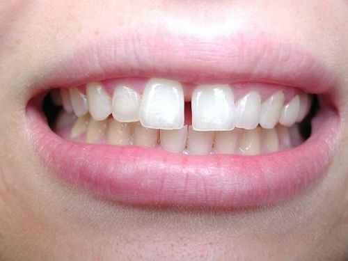 What to do when there is a gap in the front teeth?