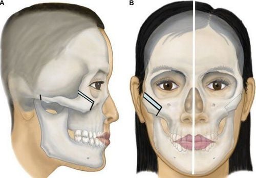 Sẹo gãy xương gò má lâu năm có tạo hình phục hồi được không?