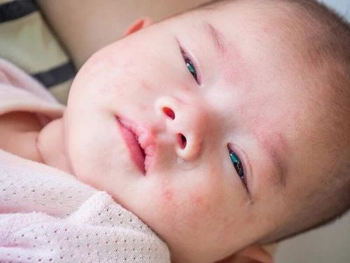 Trẻ 2 tháng tuổi bị viêm da cơ địa tái phát điều trị như thế nào?
