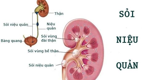 How to treat 7mm ureteral stones with blood in urine?