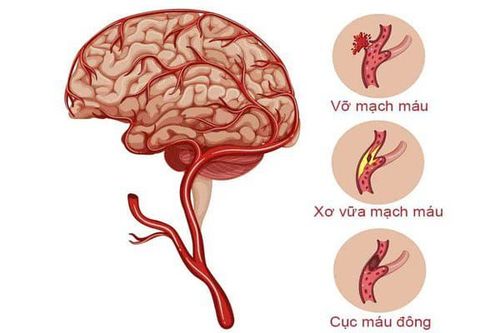 Nói không rõ sau tai biến mạch máu não có phục hồi được không?