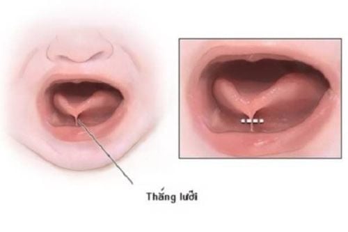 Vinmec có cắt dính thắng lưỡi cho trẻ không?