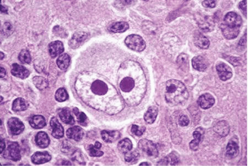 Hodgkin Lymphoma (bệnh Hodgkin) là gì?