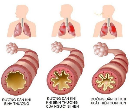 Hen phế quản mãn tính chữa khỏi được không?