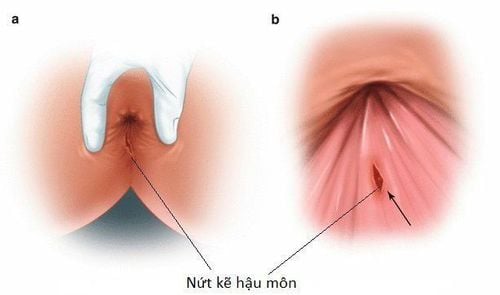 Anal fissure after treating bleeding hemorrhoids how to treat?