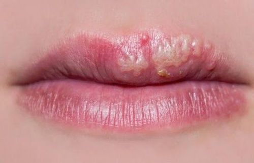 What medicine to take after tattooing lips with blisters?