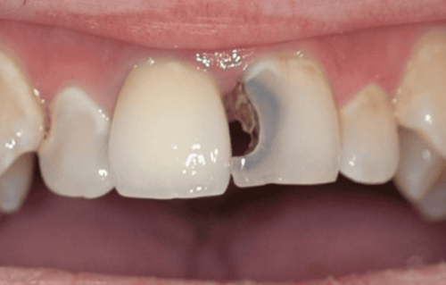 Are deep incisors durable?