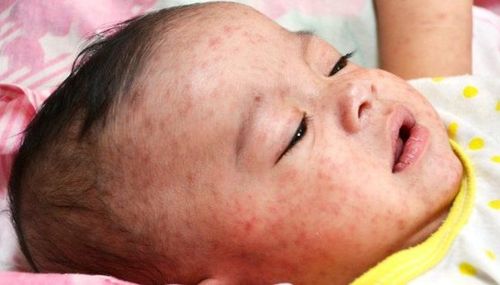 Vi khuẩn neisseria meningitidis gây viêm não mô cầu