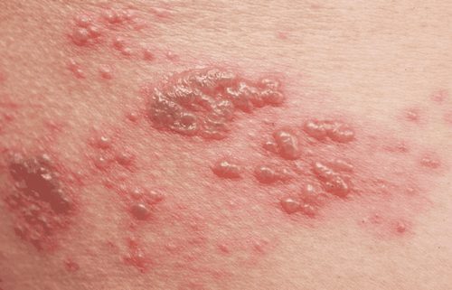 What medicine does shingles apply quickly?