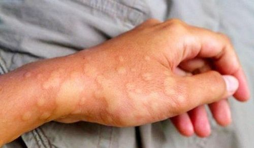 Ngứa tay chân kèm nổi cục từng mảng dấu hiệu bệnh gì?