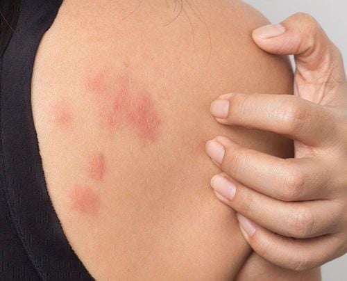 How to relieve itching when you have allergies