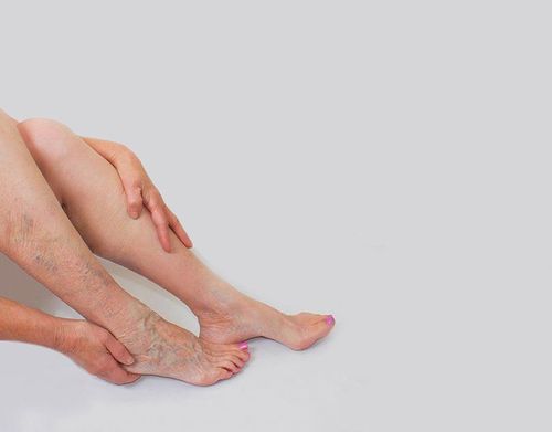 Are varicose veins effective?