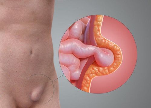 Can a 22-year-old person with an inguinal hernia have laparoscopic surgery?