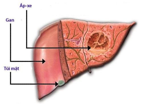 Why is liver abscess common in the right lobe?