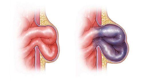 Thoát vị bẹn nghẹt ở trẻ em vì sao nguy hiểm?