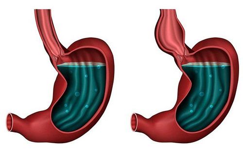 Bệnh co thắt tâm vị có nguy hiểm không?