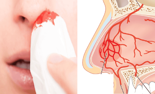 Người bị chảy máu cam nhiều lần cần phải khám gì?