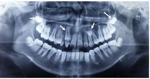 Răng thừa mọc ngầm có phải nhổ không?