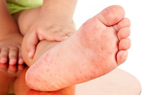 Trẻ nổi nốt sưng phù ở mu bàn chân là dấu hiệu bệnh gì?